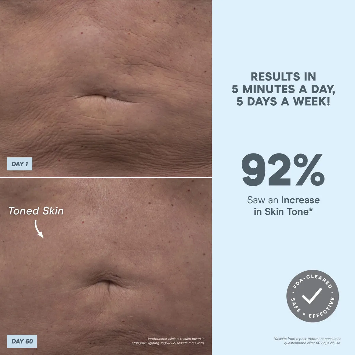 NuFACE NuBODY® 92 percent clinical results statistics graphic